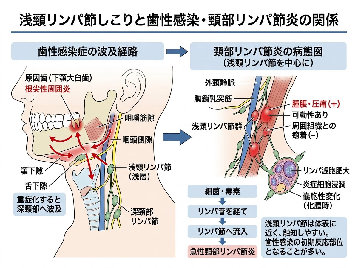 浅頸リンパ節 しこりと歯性感染・頸部リンパ節炎の関係